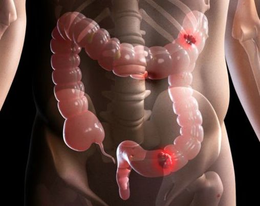 ColonAiQ multigenový krevní test pro screening a sledování nádorového onemocnění